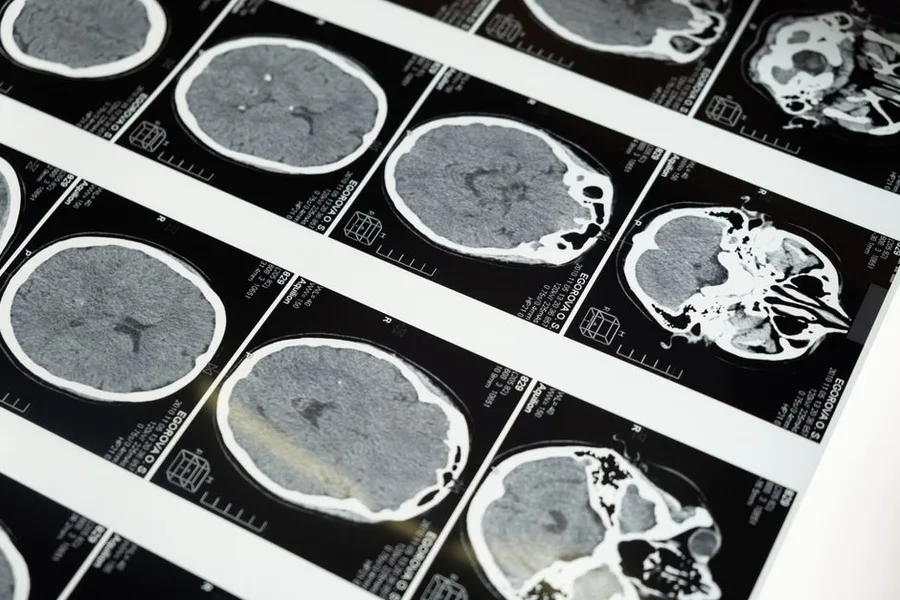 CTE Explained: Causes, Symptoms, and Diagnosis in 2026